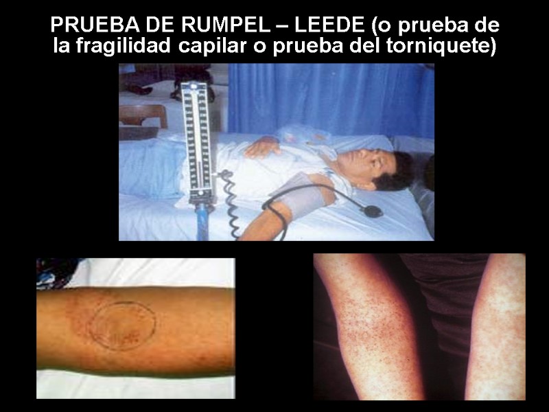 PRUEBA DE RUMPEL – LEEDE (o prueba de la fragilidad capilar o prueba del